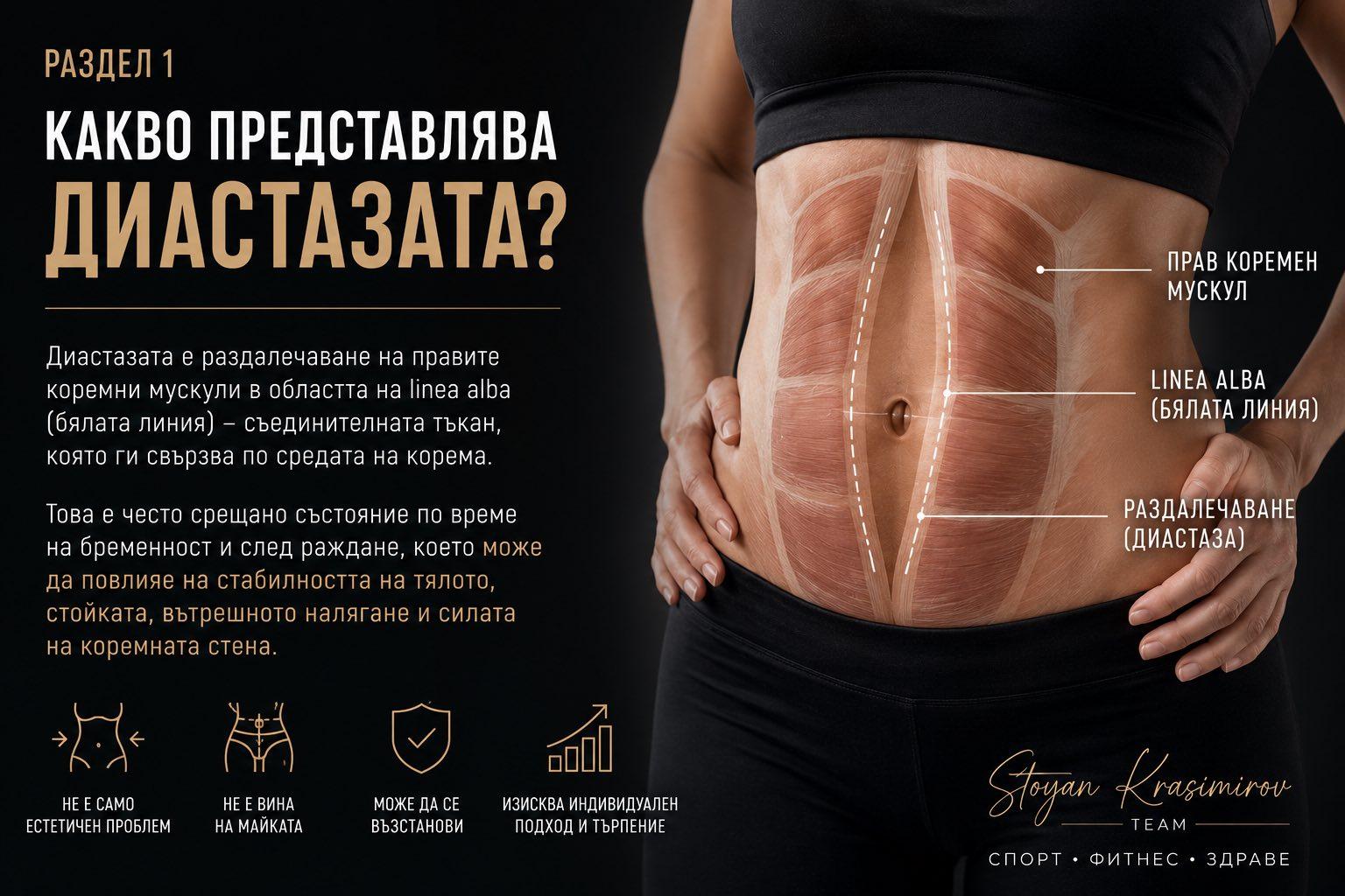Diagram: the rectus abdominis muscles, the linea alba and the separation seen in diastasis